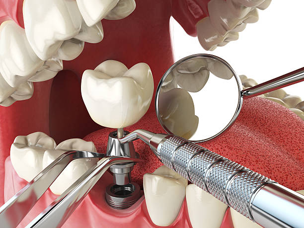 Best Emergency Tooth Extraction in Woodville, AL